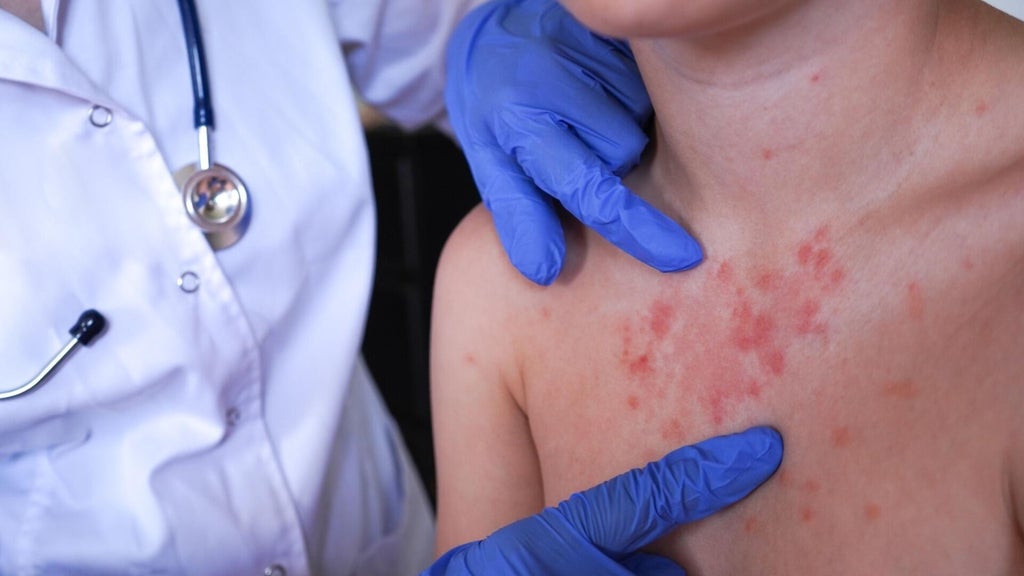 Minnesota's 80 measles cases this year are the most since 1990, health officials say — Crystal Health news