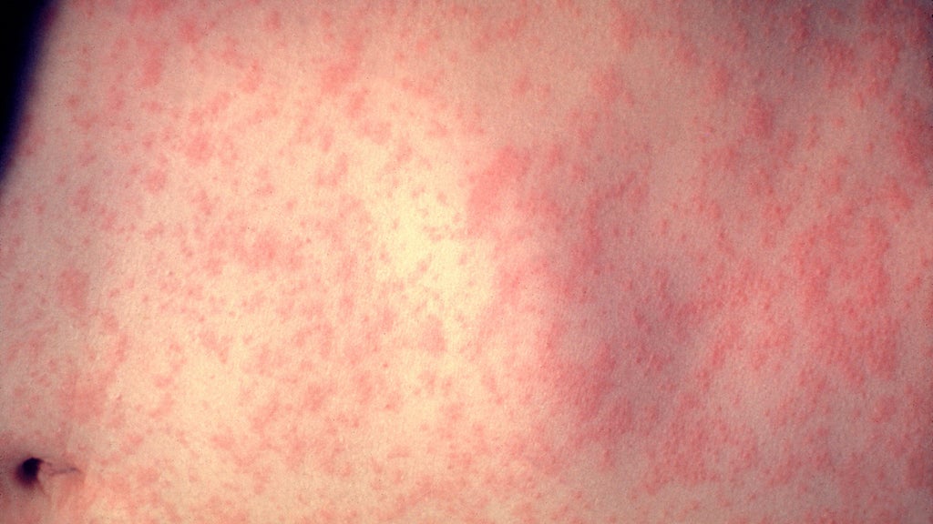 25 cases of measles identified in central, southeastern Minnesota, MDH says — WCCO / CBS Minnesota, Crystal Health news