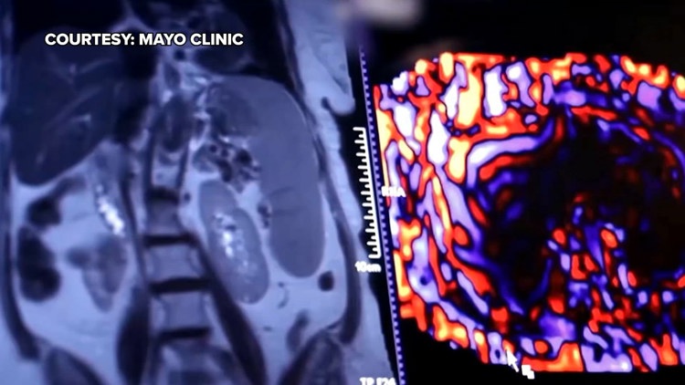 Healthy SA: Battling liver cancer, a disease which often has no symptoms early on — KENS 5 (San Antonio), Crystal Health news
